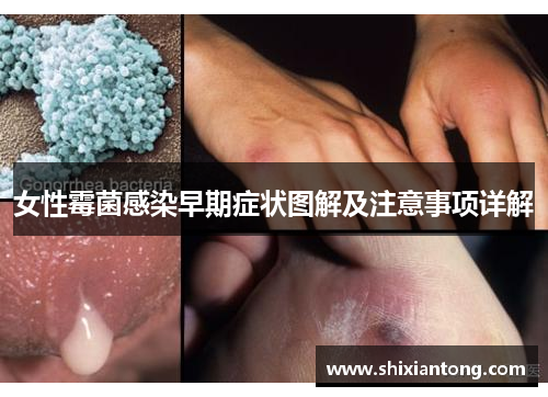 女性霉菌感染早期症状图解及注意事项详解 女性霉菌感染早期症状图解及注意事项详解